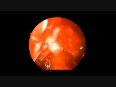 Neuropathie optique traumatique - décompression endoscopique