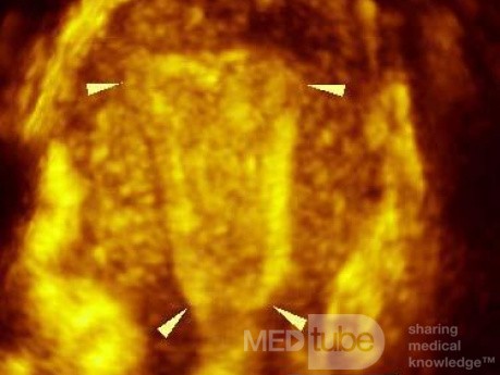 La cavité utérine normale - imagerie tridimensionnelle