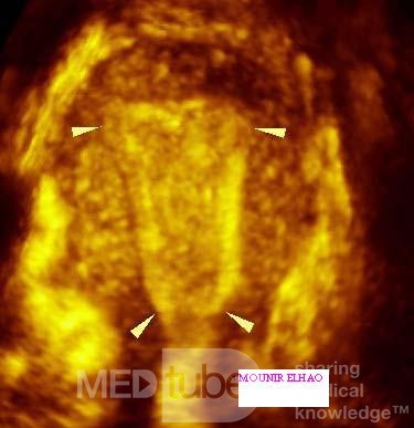 La cavité utérine normale - imagerie tridimensionnelle
