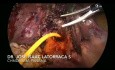 Mise en place d'un tube T par voie laparoscopique dans le syndrome de Mirizzi de type IV
