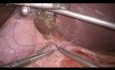 Suture Laparoscopique d'un Ulcère Duodénal avec un Patch de Graham