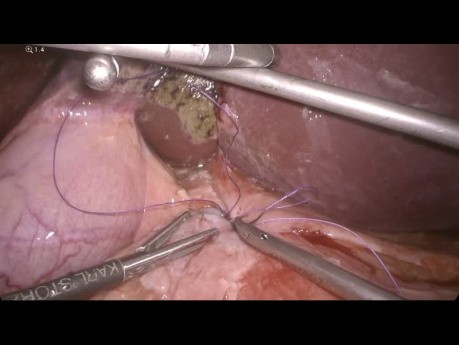 Suture Laparoscopique d'un Ulcère Duodénal avec un Patch de Graham