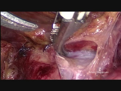 Lymphadénectomie pelvienne et aortique laparoscopique