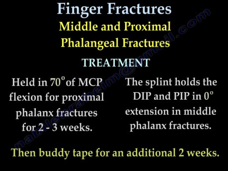 Fractures métacarpiennes et des doigts - conférence vidéo