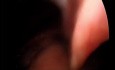 litiasis vesicular dos pinzas operadoras