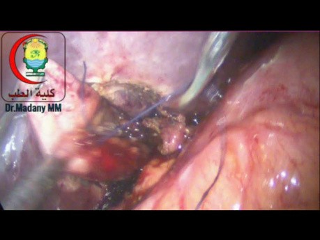 Perforation Accidentelle de la VB endant une Cholécystectomie Laparoscopique