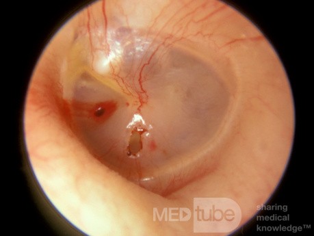 Perforation traumatique du tympan gauche