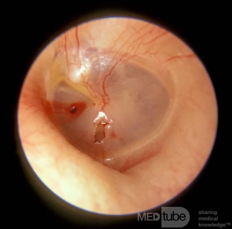 Perforation traumatique du tympan gauche