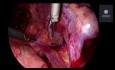 Chirurgie de l'endométriose profonde