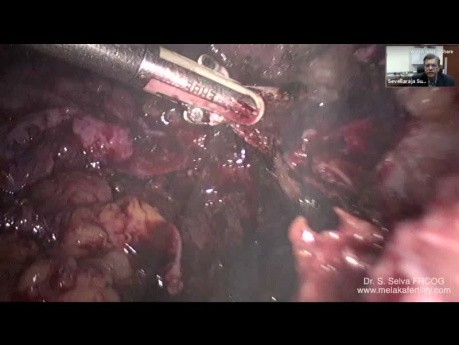 Hystérectomie laparoscopique totale dans le cas d'un gros endométriome et de l'endométriose sévère