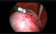 Ablation d'un grand kyste dermoïde par voie laparoscopique