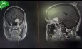 Résection d'un Méningiome du PCA (Processus Clinoïde Antérieur) par Craniotomie Fronto-temporo-pariétale Gauche