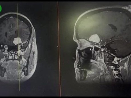 Résection d'un Méningiome du PCA (Processus Clinoïde Antérieur) par Craniotomie Fronto-temporo-pariétale Gauche