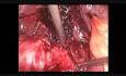 Cholécystectomie par minilaparoscopie sans clip - trucs et astuces