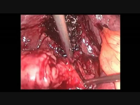 Cholécystectomie par minilaparoscopie sans clip - trucs et astuces