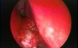 Éperon sur la cloison nasale - ablation par endoscopie