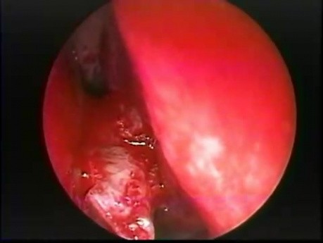 Éperon sur la cloison nasale - ablation par endoscopie