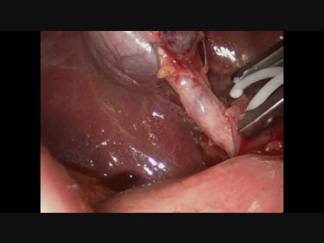 Cholécystectomie radicale par voie laparoscopique
