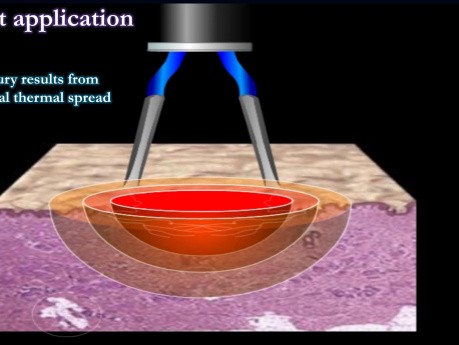 Utilisation sûre de l'électrochirurgie - un aperçu