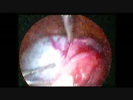 Kystectomie par coelioscopie Kyste paratubaire gauche