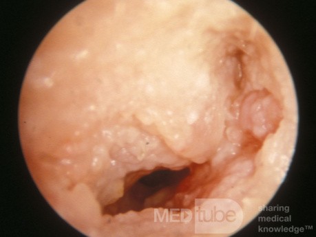 Carcinome épidermoïde du conduit auditif externe