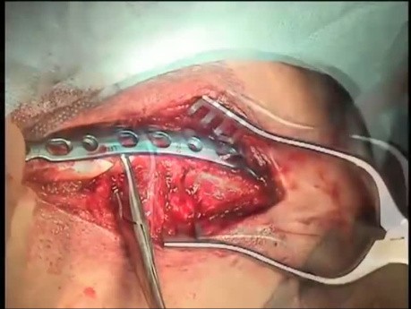 Fracture de la Clavicule - Chirurgie de la Clavicule 