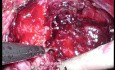 Prostatectomie Radicale Laparoscopique