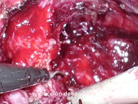Prostatectomie Radicale Laparoscopique
