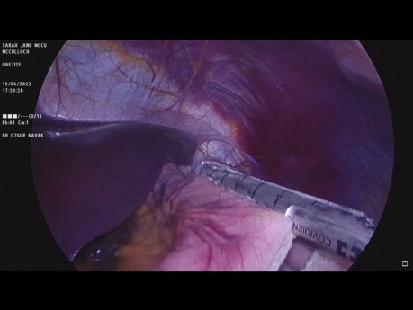Chirurgie de la sleeve gastrectomie (3 trous de serrure, double couche, technique de point)