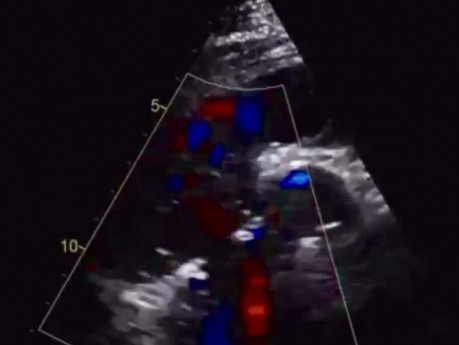 9. Cas d'échocardiographie - Qu'est-ce que vous voyez ?