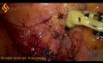 Lymphadénectomie laparoscopique pour le cancer du côlon droit