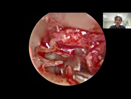 Stapédotomie Endoscopique avec Microdrill pour Otosclérose
