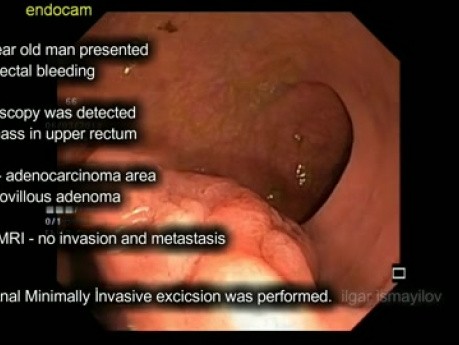 Microchirurgie transanale endoscopique (TEM) pour adénocarcinome du rectum proximal T1