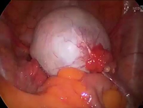 La kystectomie ovarienne dans un sac (endobag).