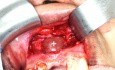 Kyste Apical