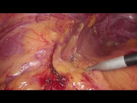 Mobilisation de l'artère de Moskowitz et de la flexion splénique pendant la résection laparoscopique du sigmoïde