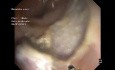 Dissection Sous-Muqueuse + Clip pour Plaie de Résection 