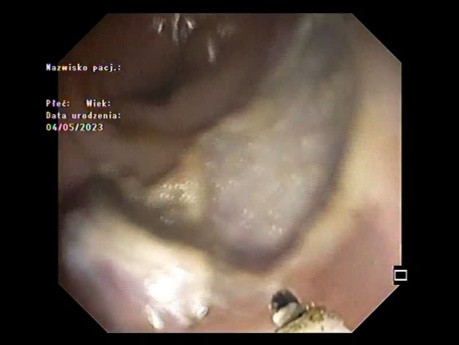 Dissection Sous-Muqueuse + Clip pour Plaie de Résection 