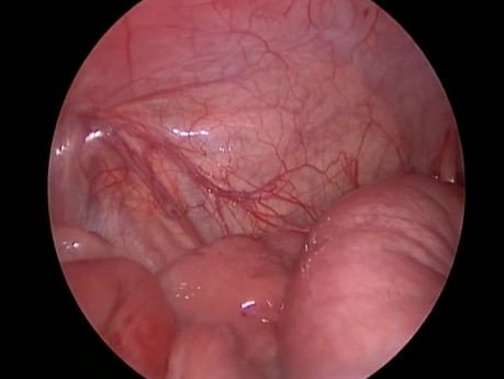 Réduction laparoscopique de l'intussusception iléo-colique chez le nourrisson