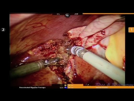 Résection Robotisée du Foie