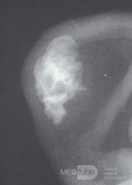 Ossification induite par les engelures du cartilage auriculaire