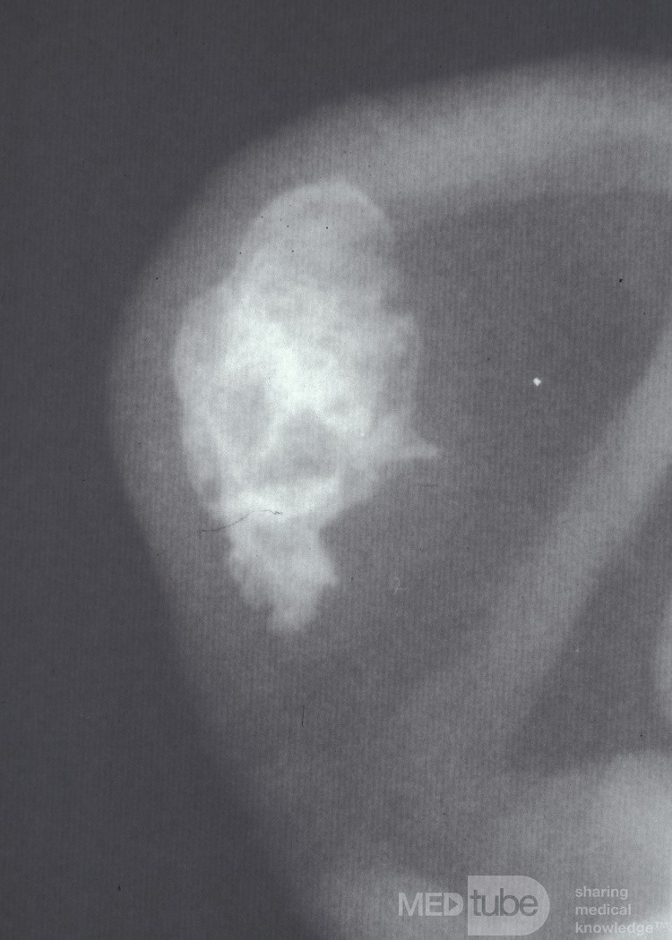 Ossification induite par les engelures du cartilage auriculaire