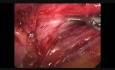 Fundoplicature de Nissen par voie laparoscopique