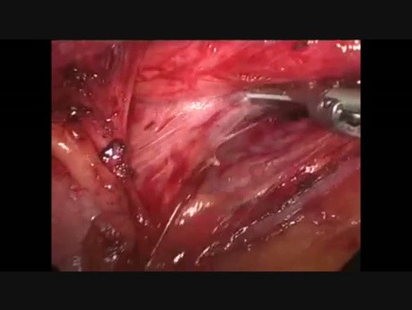 Fundoplicature de Nissen par voie laparoscopique