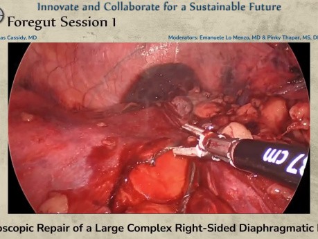 Réparation Laparoscopique d'une Volumineuse Hernie Diaphragmatique Complexe Droite