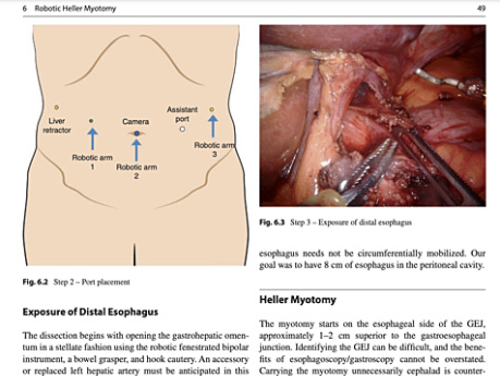 Chirurgie mini-invasive assistée par robot