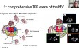 Évaluation Echocardiographique de la Valve Mitrale en Vue de Valvuloplastie