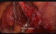Chirurgie laparoscopique de l'endométriome
