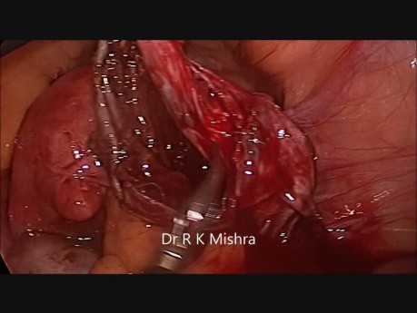 Chirurgie laparoscopique de l'endométriome