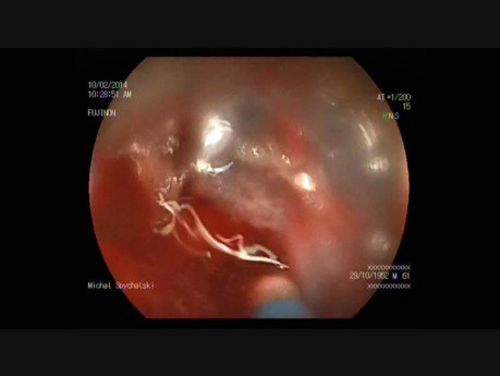  La dissection sous muqueuse ou ESD (endoscopic submucosal dissection) de la tumeur colorectal. 